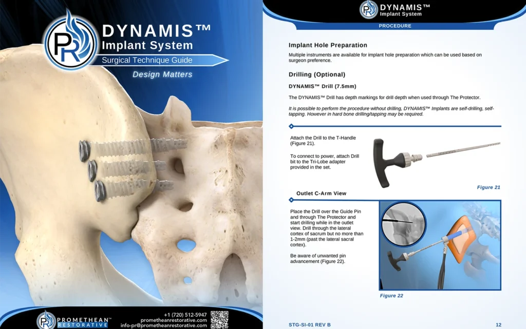 Dynamis Implant System Surgical Technique Thumbnail